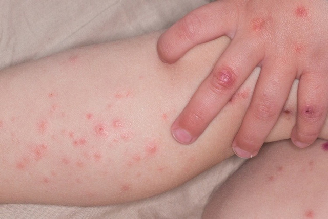 The HFMD outbreak 2026: Why severe cases rise in south Vietnam?