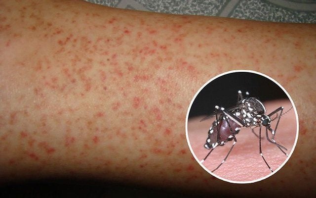 Strengthening Surveillance, Prevention, and Control of Dengue Fever