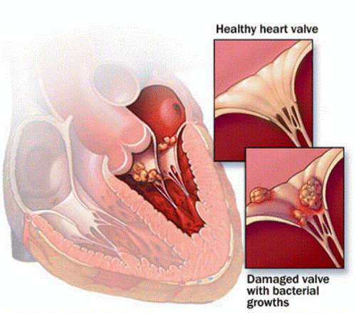Information on Infective Endocarditis