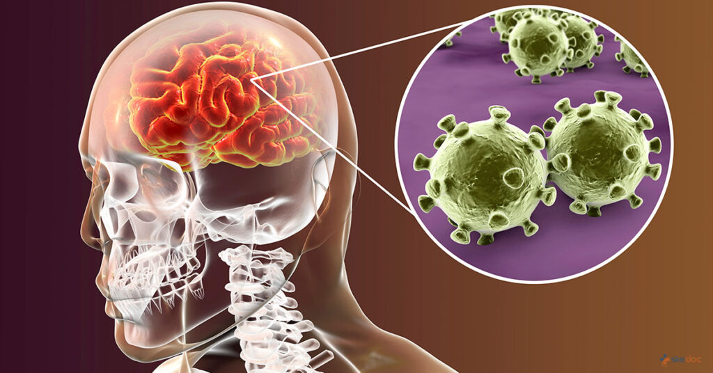 Overview of Meningitis