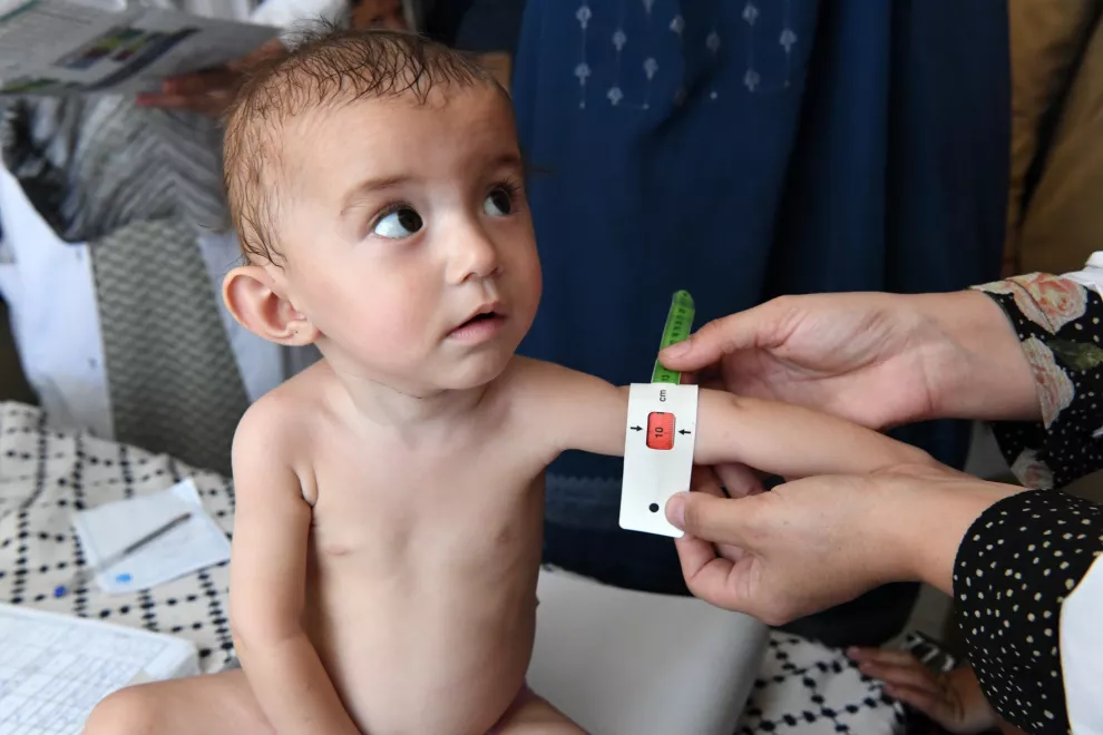 Acute malnutrition in children aged 0 to 72 month