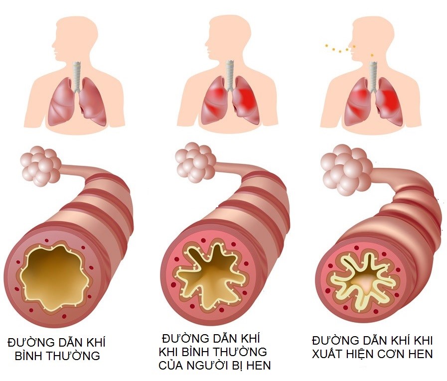 Chẩn đoán và điều trị Hen phế quản người lớn và trẻ em từ 12 tuổi